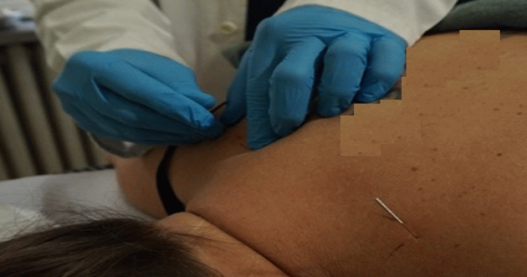 Dry Needling